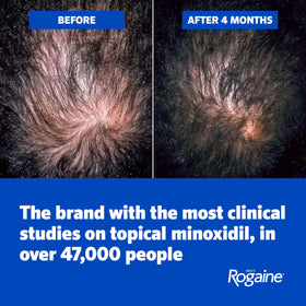 Application of Rogaine foam to a male scalp demonstrating simple twice-daily use benefit