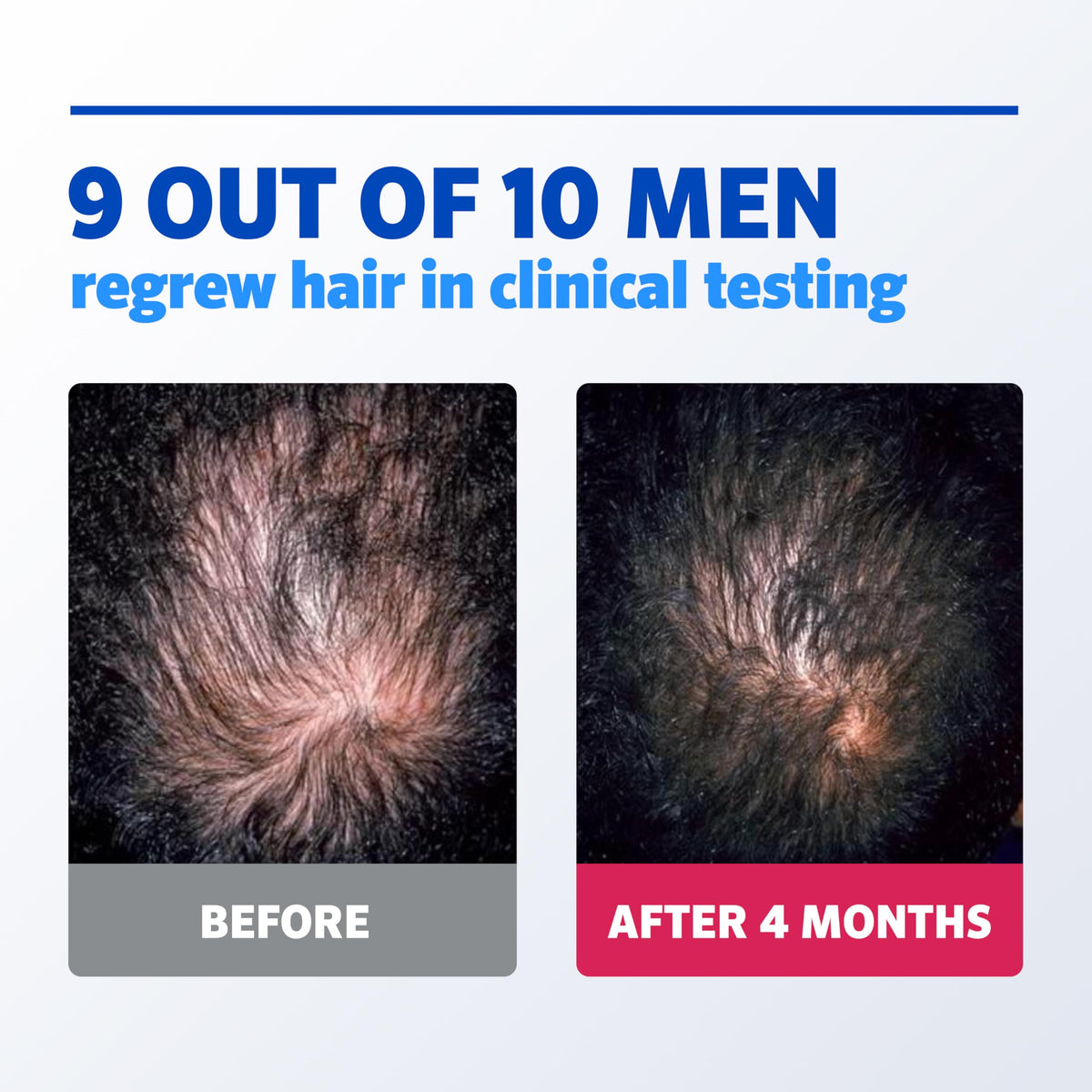 Rogaine label detail highlighting 5% minoxidil active ingredient