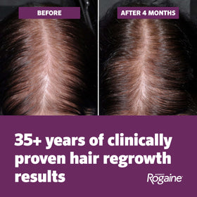 Rogaine foam being applied to scalp demonstrating targeted coverage benefit
