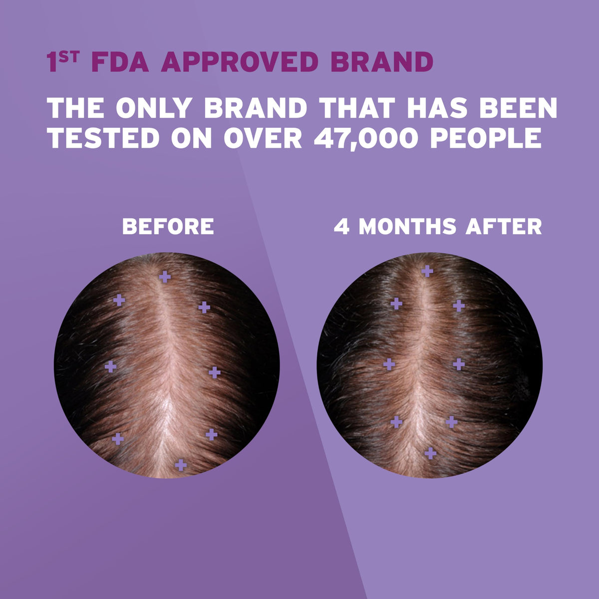 Rogaine applicator close-up on scalp demonstrating precise, mess-free application