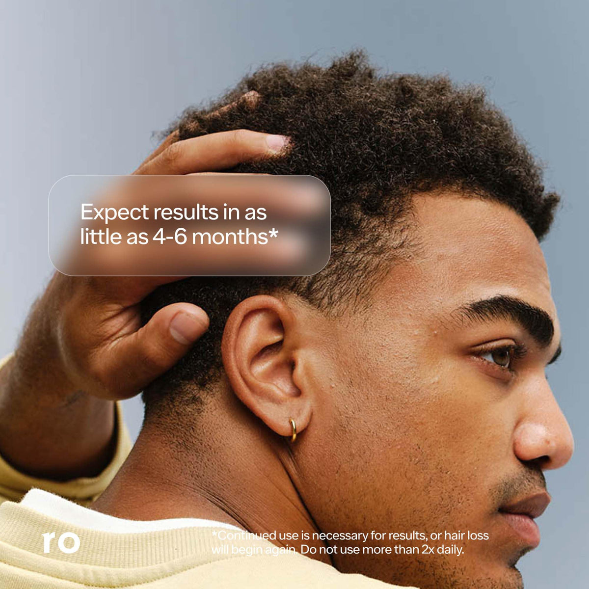 Ro ROMAN solution applied to male scalp demonstrating targeted treatment benefit