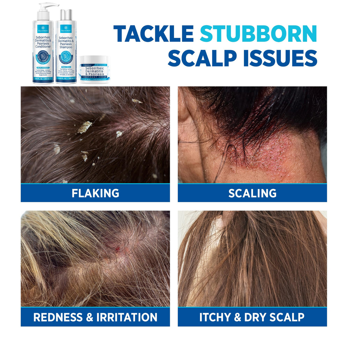 roycederm cream applied to scalp showing targeted soothing benefit