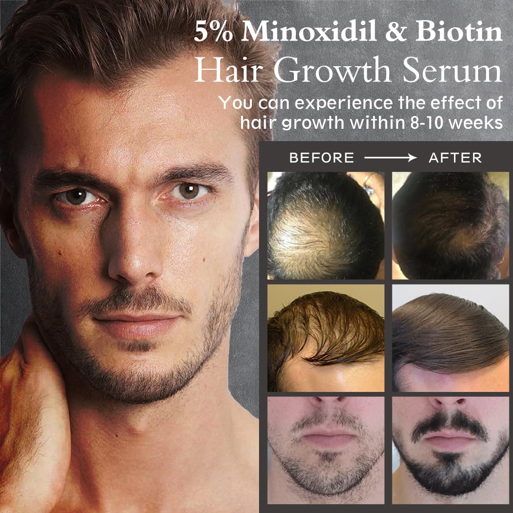 Ruahouine scalp application to target thinning areas effectively