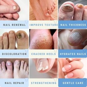 Scientific Solutions Global applied to toenail demonstrating targeted softening