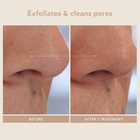 SHANI DARDEN mask massaged into skin showing soothing neutralizer and pore-clearing benefit
