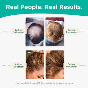 Shapiro MD in-use scalp massage scene demonstrating targeted application and improved coverage benefit