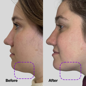 SickScience serum applied under chin showing targeted lifting benefit