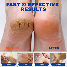 SKIN ULTIMA applied to cracked heel showing visible softening benefit