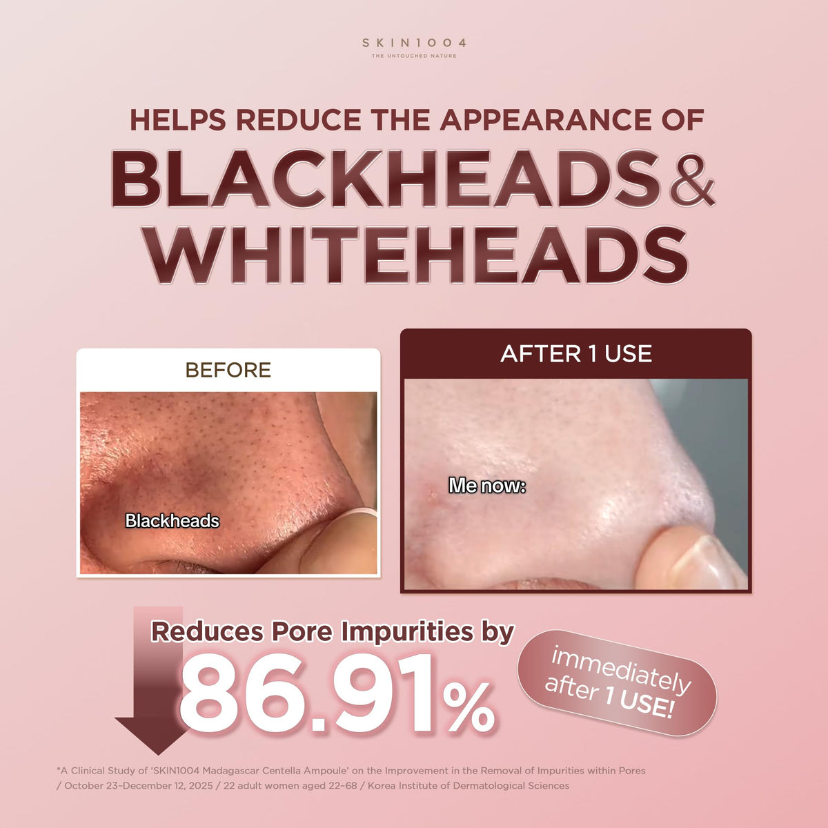 applying SKIN1004 to cheek demonstrating targeted pore treatment benefit