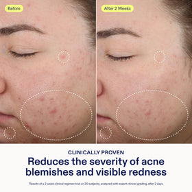 Skinfix applied to jawline demonstrating focused spot treatment benefit