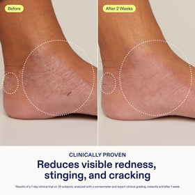 Skinfix applied to dry hands in use, shows immediate soothing and protection