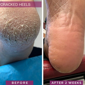 SkinIntegra being applied to a cracked heel to demonstrate relief
