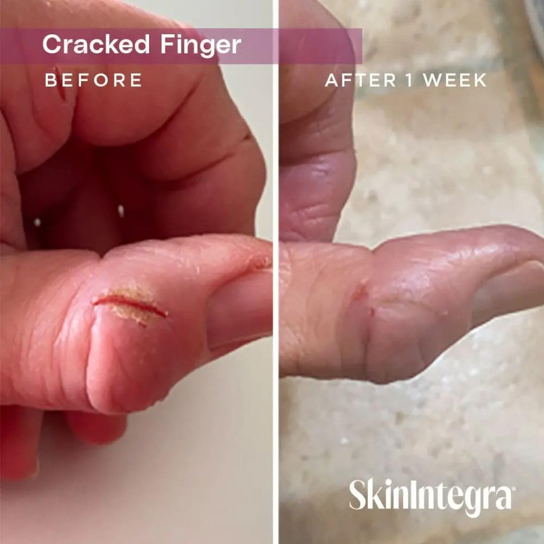 SkinIntegra 3 oz tube next to a ruler to show portable size