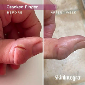 SkinIntegra 3 oz tube next to a ruler to show portable size