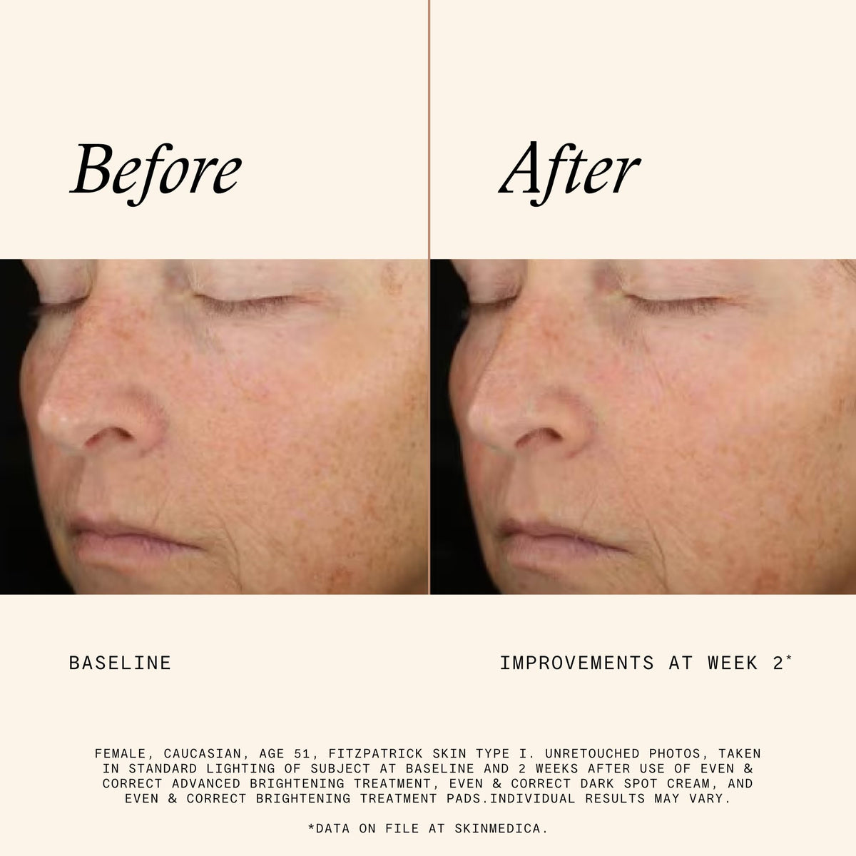 SkinMedica open tub with stacked pads illustrating ready-to-use convenience