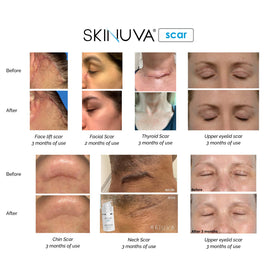 Skinuva used in postpartum setting showing gentle, pregnancy-safe care