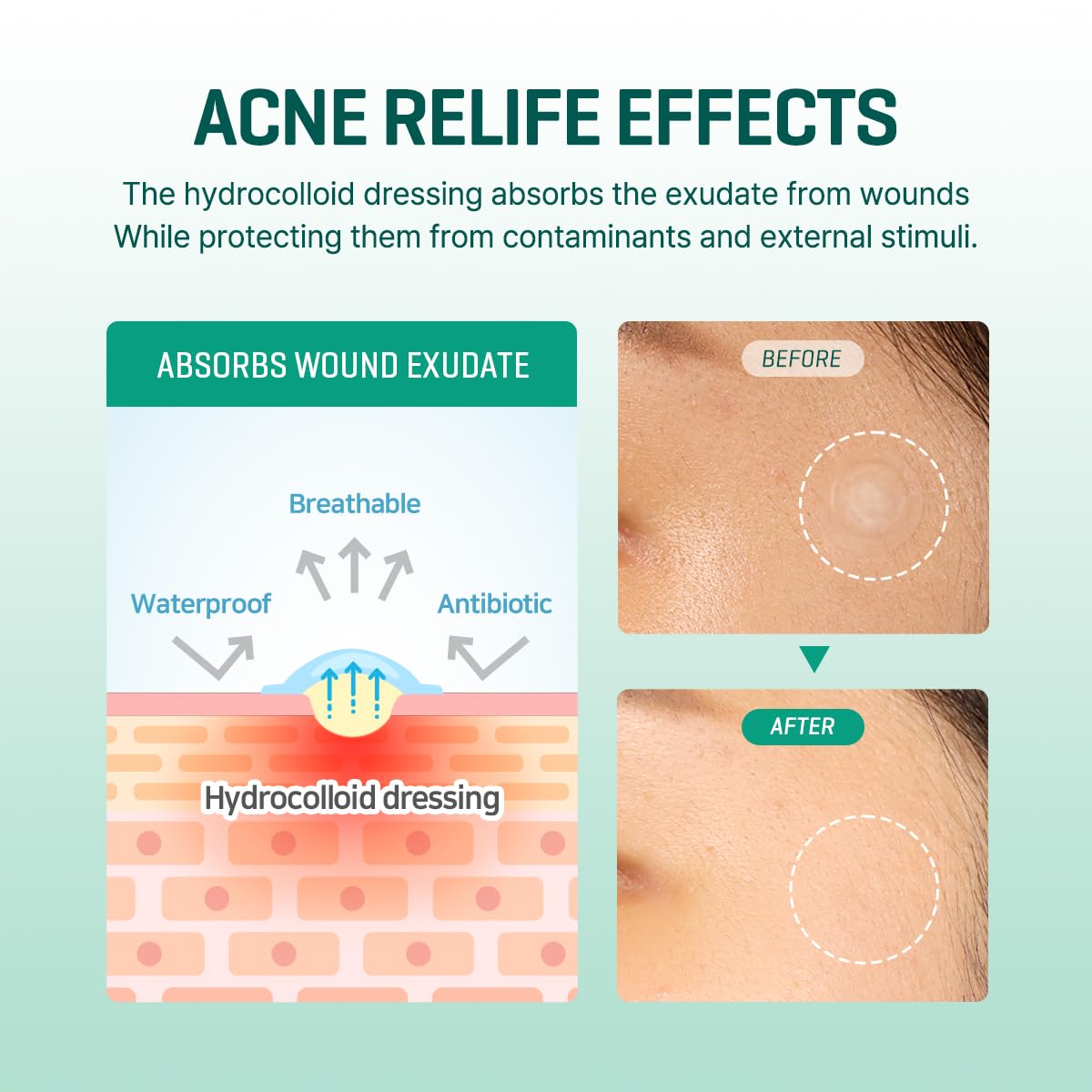 SOME BY MI patch applied to cheek demonstrating secure adhesion and protection