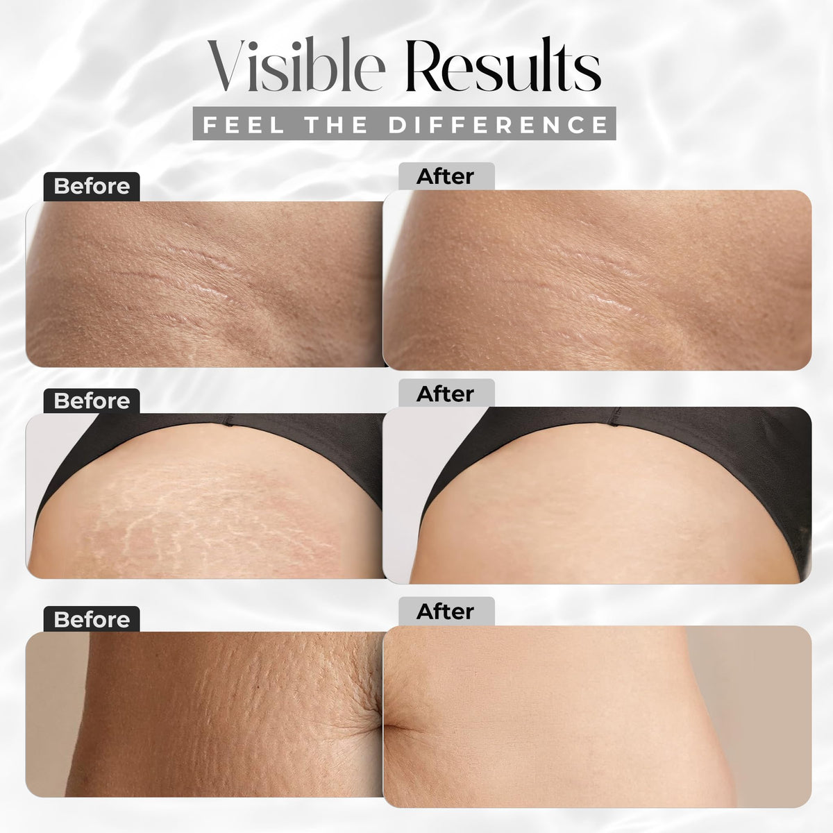 StretchMarkers being applied to abdomen showing targeted treatment benefits