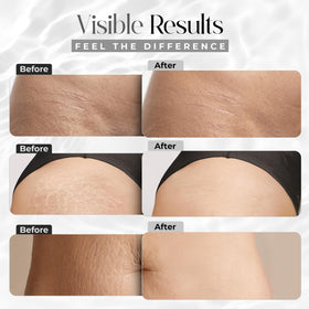 StretchMarkers being applied to abdomen showing targeted treatment benefits
