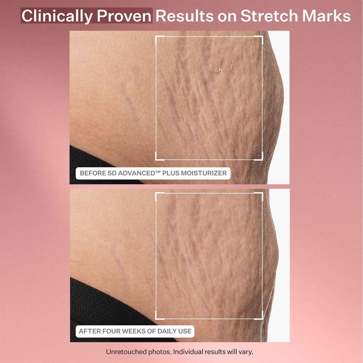 StriVectin spread on thigh showing body stretchmark treatment benefit