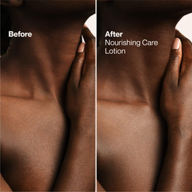 Suave shea butter applied to elbow to reduce roughness and dryness