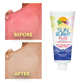 Sunburnt ingredients label highlighting botanicals and lidocaine benefit