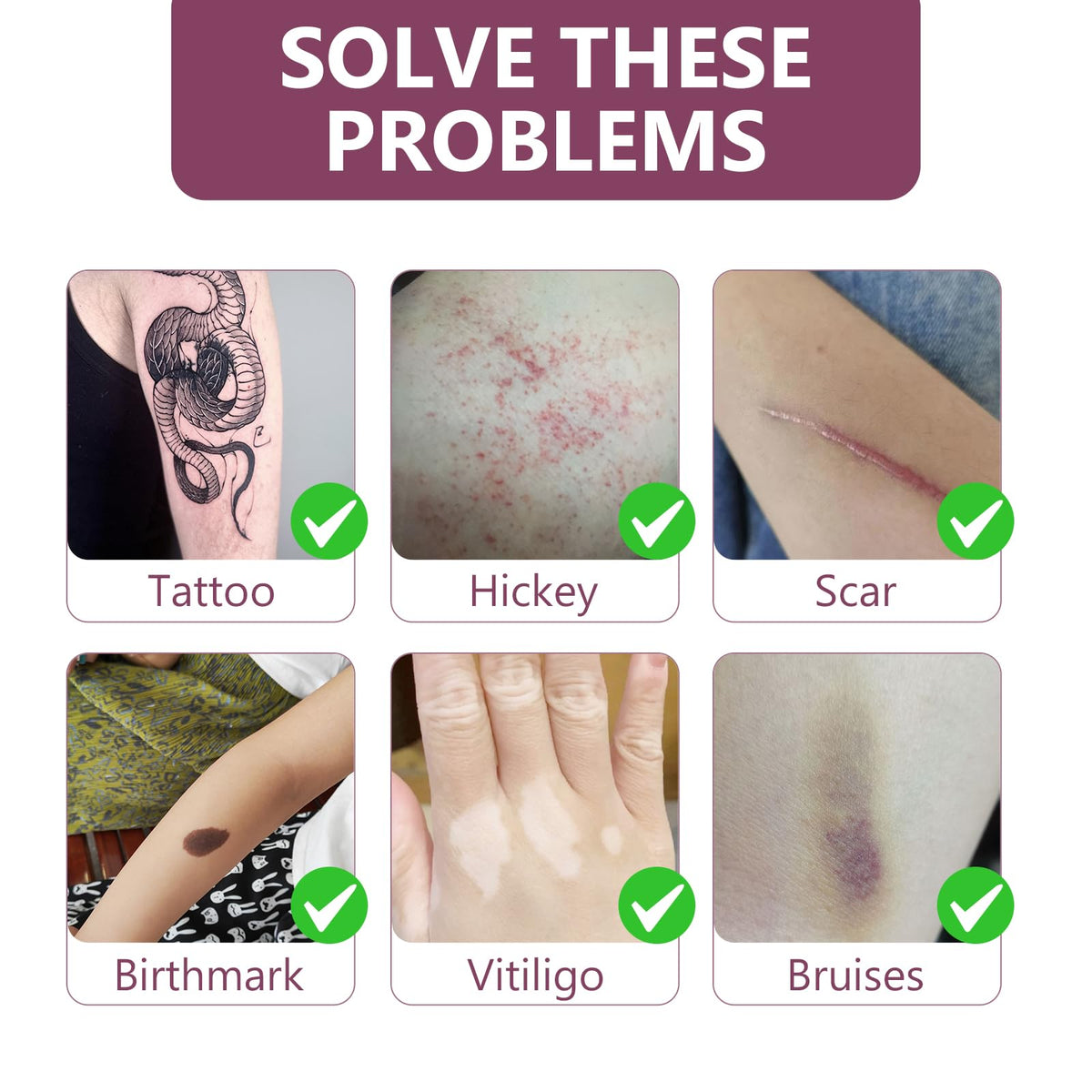 SUPVIN patch on forearm blending with skin tone and providing natural coverage