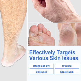 TEAWOO applying cream to heel demonstrating targeted softening action