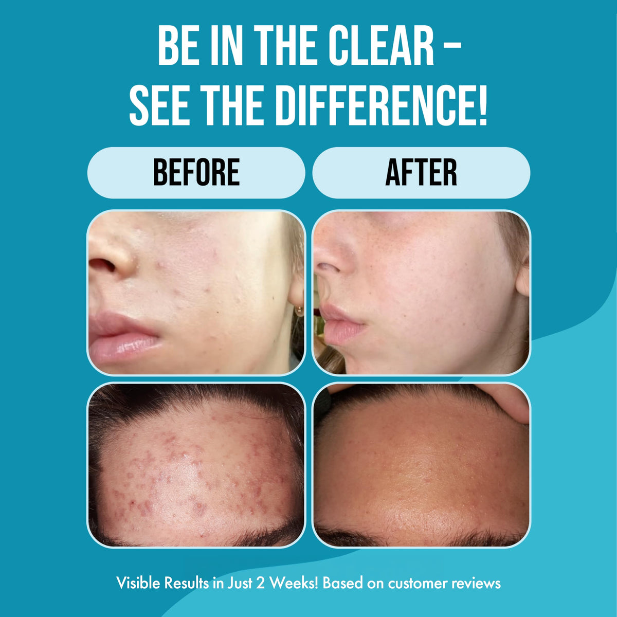 Teenology bottle label detail highlighting non-comedogenic and clean ingredients benefit