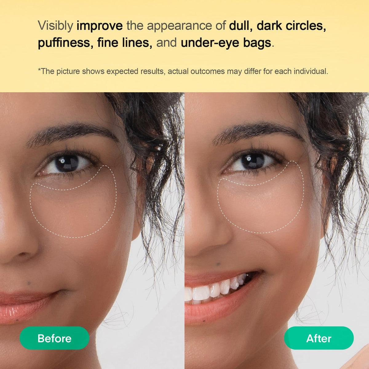 TEREZ & HONOR small patch on smile line delivering targeted smoothing