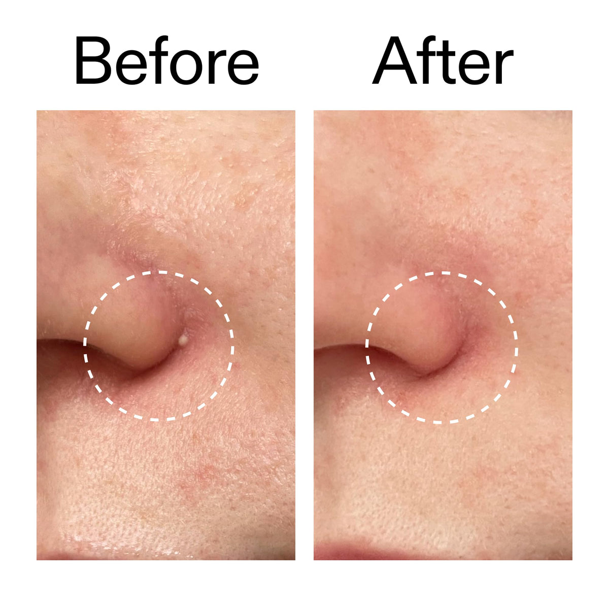 The INKEY List ingredient graphic with salicylic, succinic and ectoin benefits