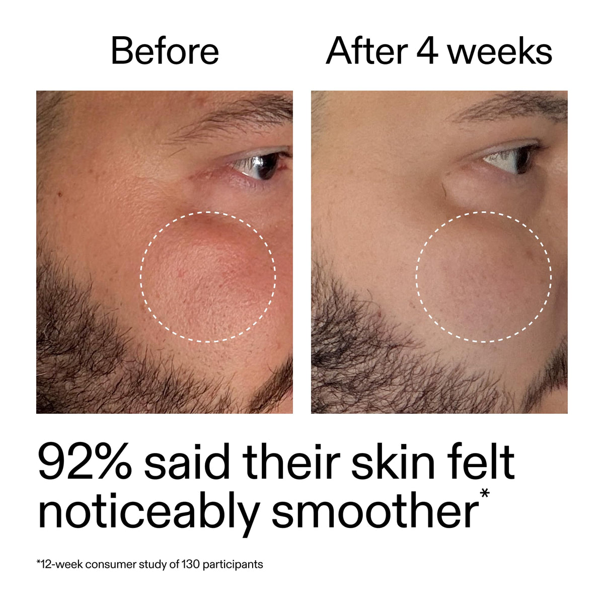 Model with sensitive skin demonstrating The INKEY List gentle comfort