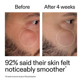 Model with sensitive skin demonstrating The INKEY List gentle comfort