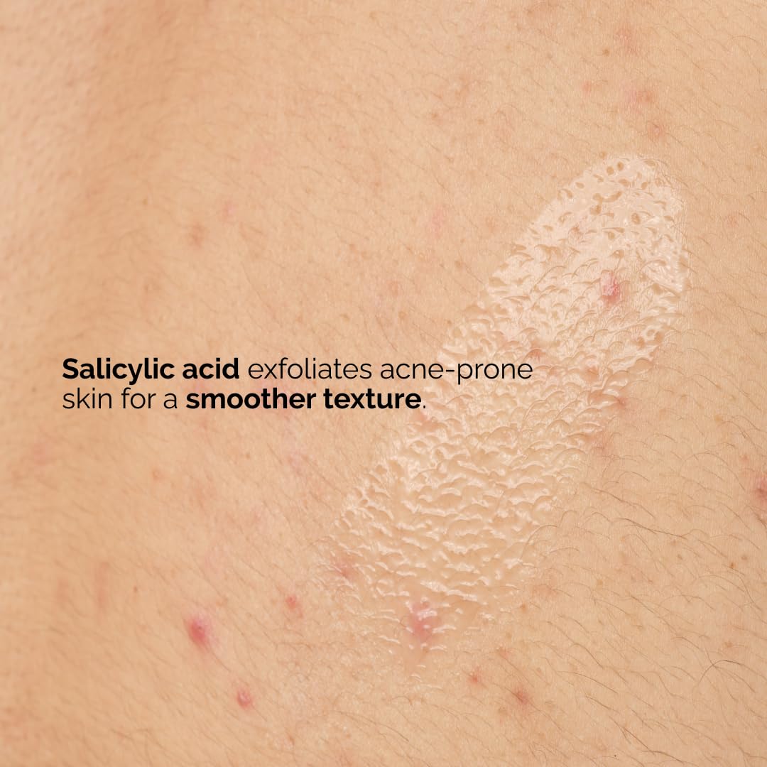 The Ordinary being applied to back showing targeted treatment for body blemishes