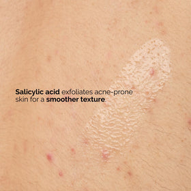 The Ordinary being applied to back showing targeted treatment for body blemishes