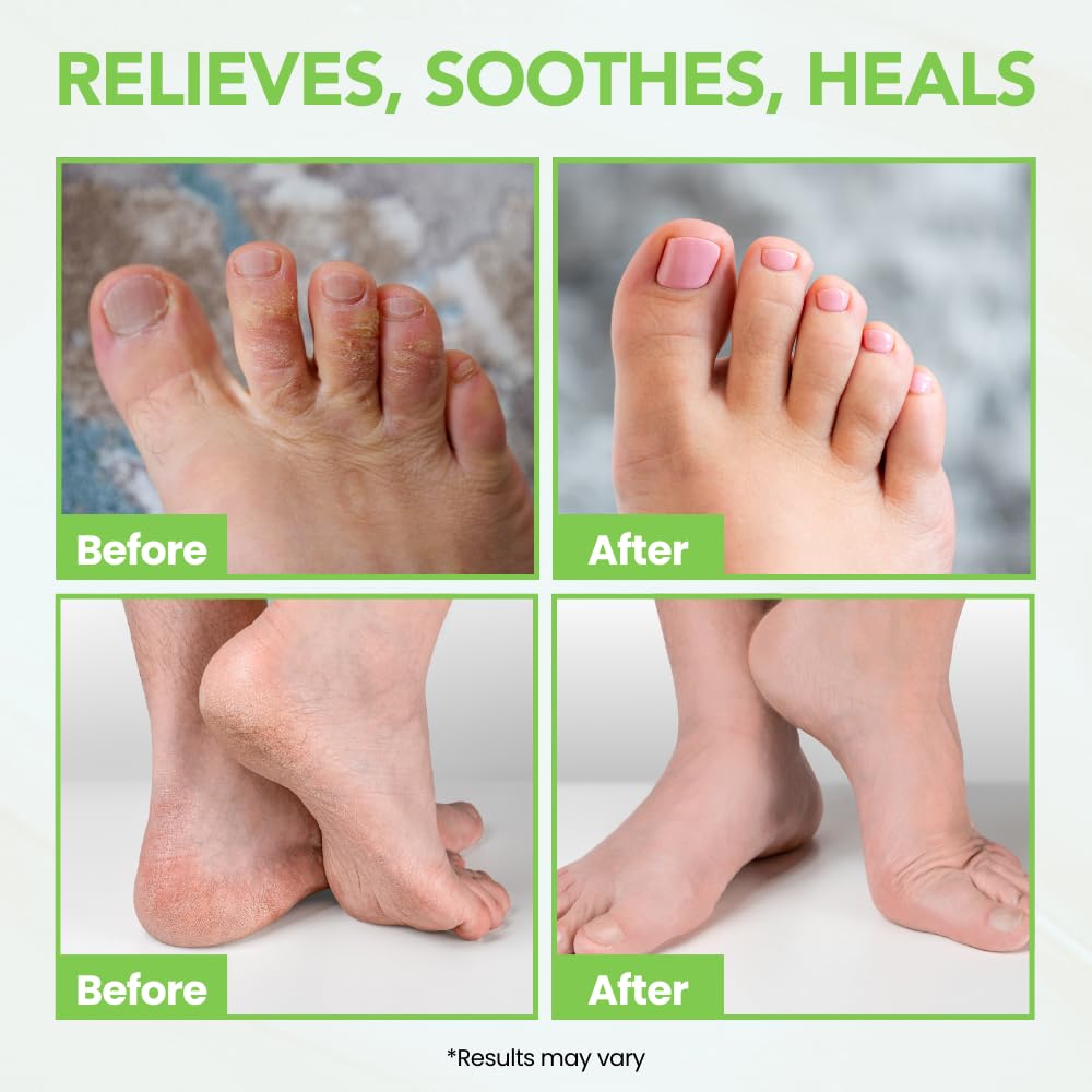 THENA applying cream between toes to soothe itch and restore comfort