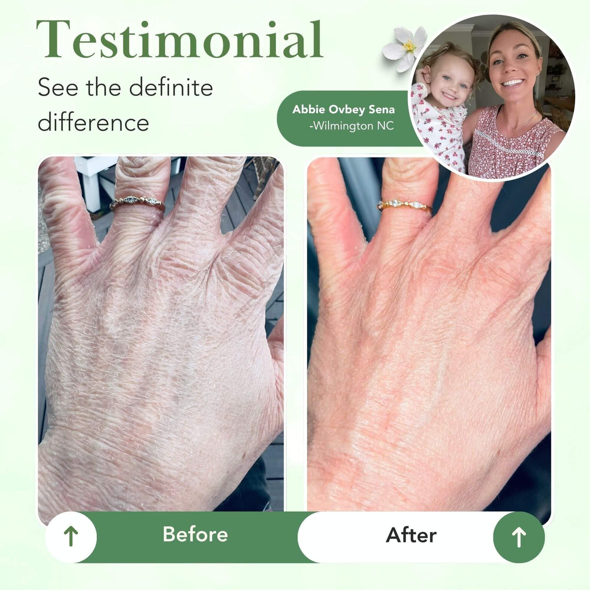 Theraplex being applied to a hand demonstrating quick soothing hydration