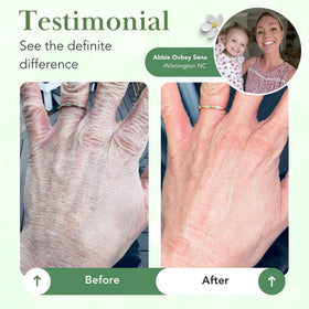 Theraplex being applied to a hand demonstrating quick soothing hydration
