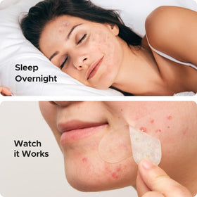 TKTK small dot patches array highlighting spot treatment options