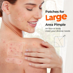 TKTK strip patches applied to a model's back demonstrating full coverage benefit
