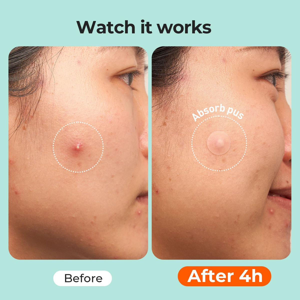 TKTK XL strip on chin covering multiple blemishes for wider area use