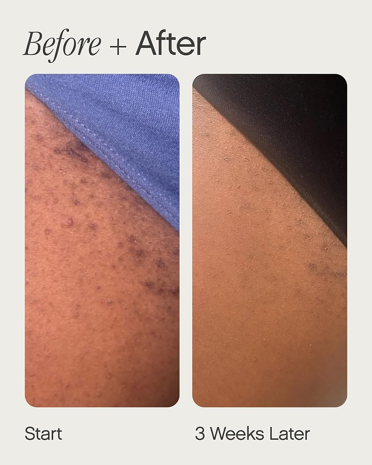 Topicals High Roller applied to bikini area illustrating targeted soothing and bump reduction