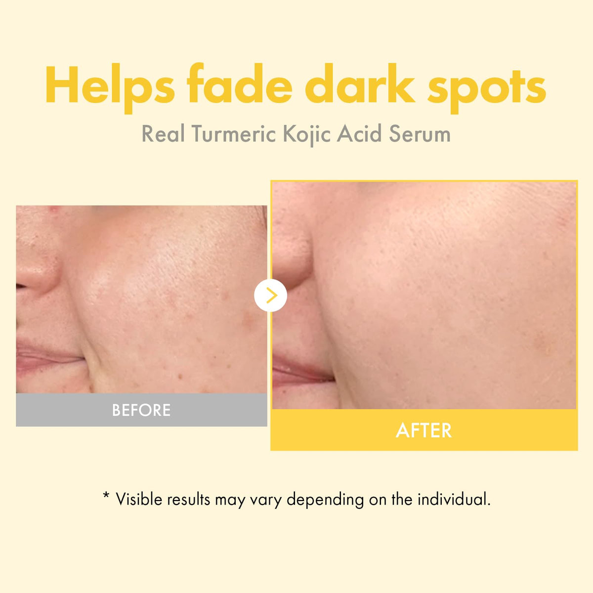 TOSOWOONG applying serum to dark spot demonstrating targeted correction