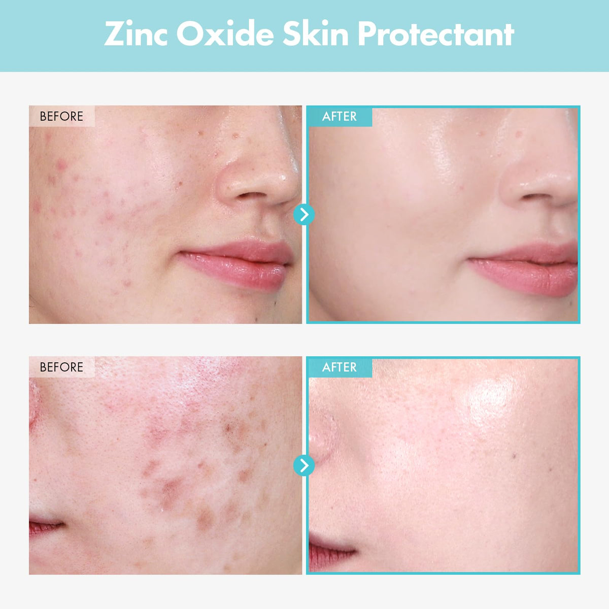 TOSOWOONG zinc ingredient display highlighting zinc oxide powder benefit