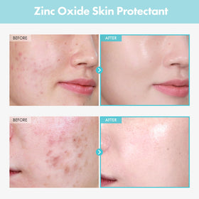 TOSOWOONG zinc ingredient display highlighting zinc oxide powder benefit