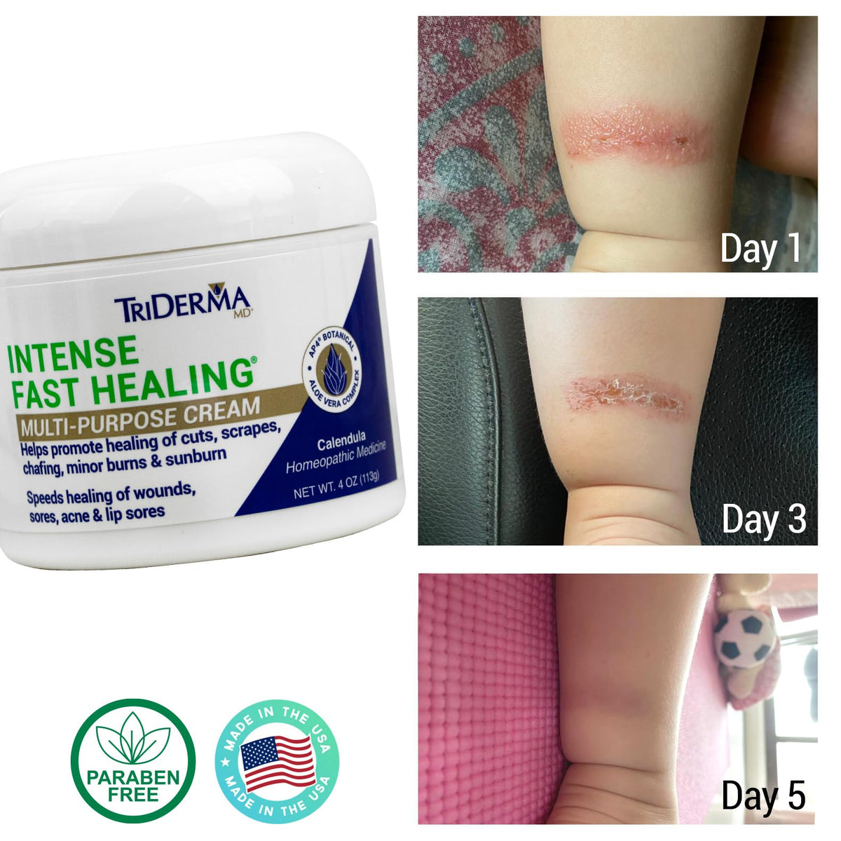 TriDerma cream on hand demonstrating quick absorption and moisturization