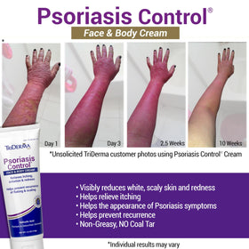 TriDerma cream being dispensed onto hand for easy application benefit
