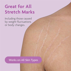 TriLASTIN lifestyle maternity use featuring expectant mother applying cream for support benefit