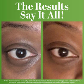 TruSkin before and after under-eye comparison, illustrates brighter look