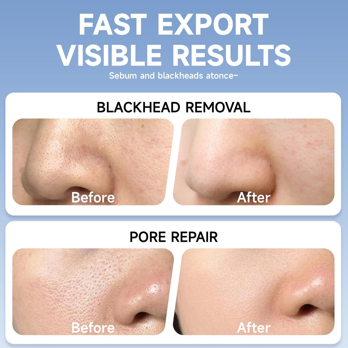 TrySafe extraction scraper and tools beside pads, helps controlled blackhead removal